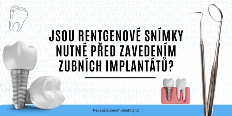 Jsou rentgenové snímky nutné před zavedením zubních implantátů