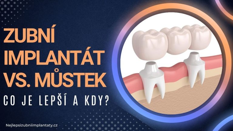 Zubní implantát vs. můstek_ Co je lepší a kdy